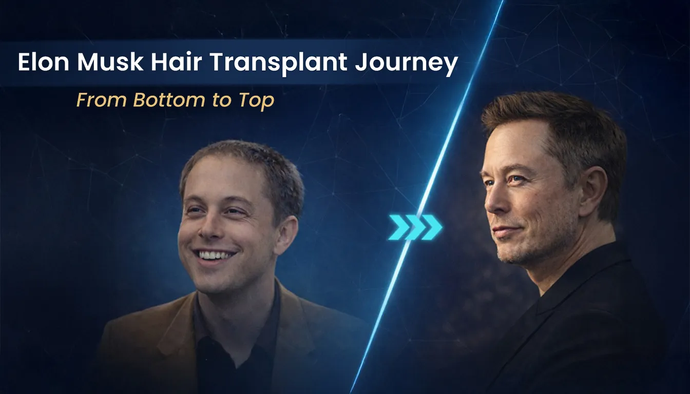 Elon Musk Hair Transplant Success Story: Before And After 1 Elon Musk Hair Transplant Success Story: Before And After