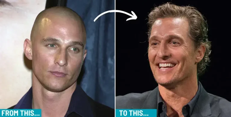 Matthew-Mcconaughey-3-1-768X390 America’s #1 Producer Matthew Mcconaughey Hair Transplant