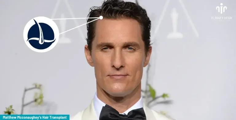 Matthew-Mcconaughey-8-1-768X390 America’s #1 Producer Matthew Mcconaughey Hair Transplant