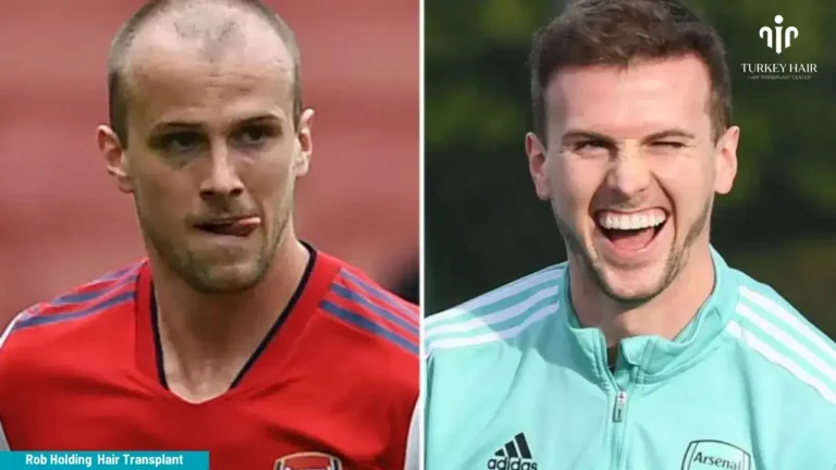 Rob-Holding-Hair-Transplant-1-1-768X432 Rob Holding Hair Transplant