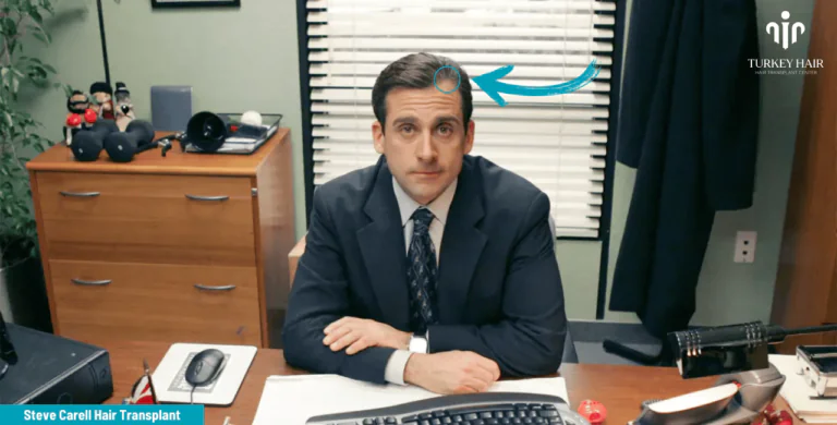 Steve-Carells-Hair-Transplant-1-768X390.Png #1 Actor Steve Carell’s Hair Transplant