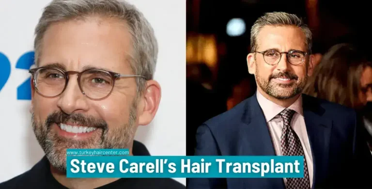 Steve-Carells-Hair-Transplant-4-1-768X390 #1 Actor Steve Carell’s Hair Transplant