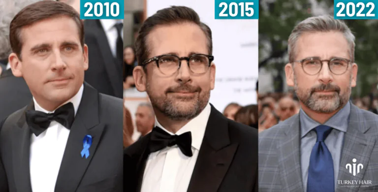 Steve-Carells-Hair-Transplant-5-768X390.Png #1 Actor Steve Carell’s Hair Transplant