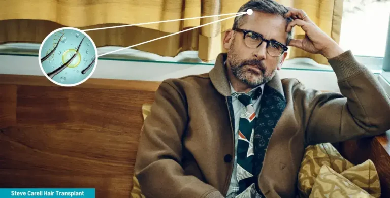 Steve-Carells-Hair-Transplant-6-1-768X390 #1 Actor Steve Carell’s Hair Transplant