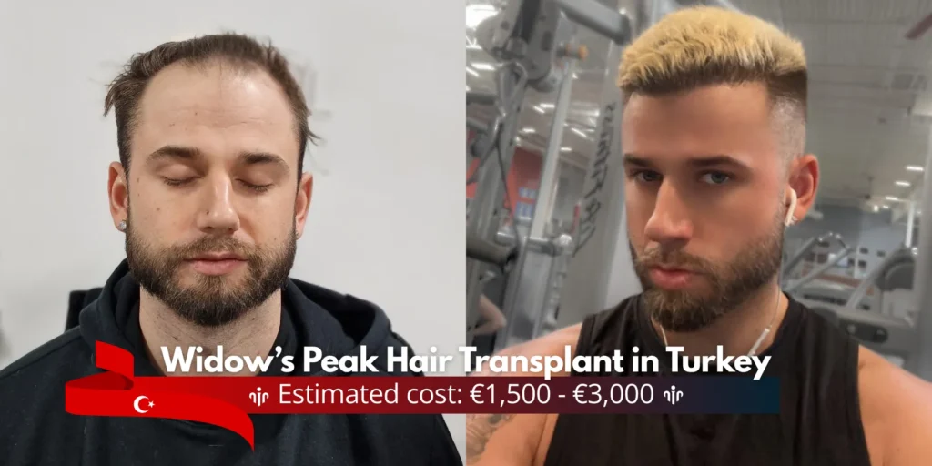 Widows-Peak-Hair-Transplant-Cost-In-Turkey Widow’s Peak Hair Transplant In Turkey – Cost- Before And After