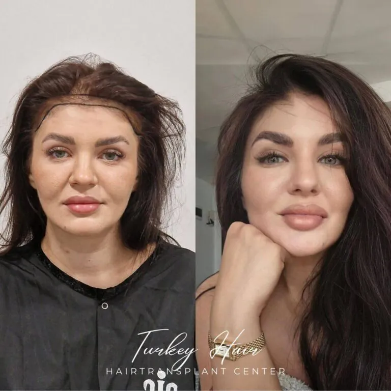 Women-1000-Grafts-Hair-Transplant-Before-After-768X768.Jpg 1000 Grafts Hair Transplant In Turkey – Cost – Before And After