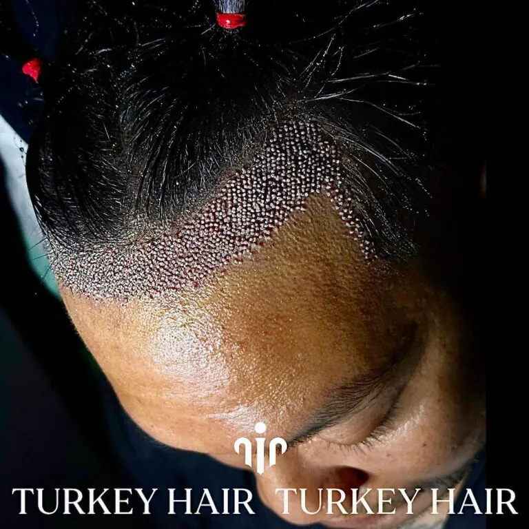 After-1000-Grafts-Hair-Transplant-768X768.Jpg 1000 Grafts Hair Transplant In Turkey – Cost – Before And After