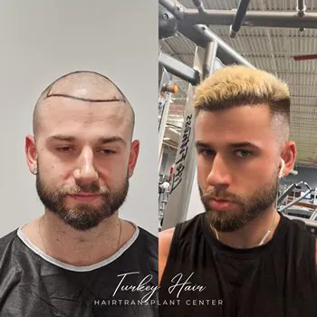 Fue Hair Transplant In Turkey – Cost, Before &Amp; After