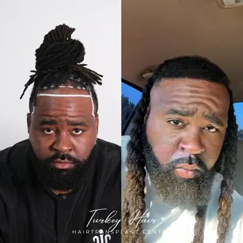 Fue Hair Transplant In Turkey – Cost, Before &Amp; After