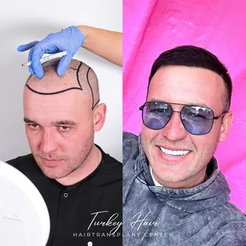 Fue Hair Transplant In Turkey – Cost, Before &Amp; After