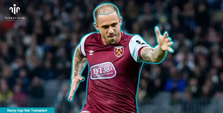 Danny-Ings-Hair-Transplant-2-1-768X390 Let’s Discover Succesfull Striker Danny Ings’ Hair Transplant 2026