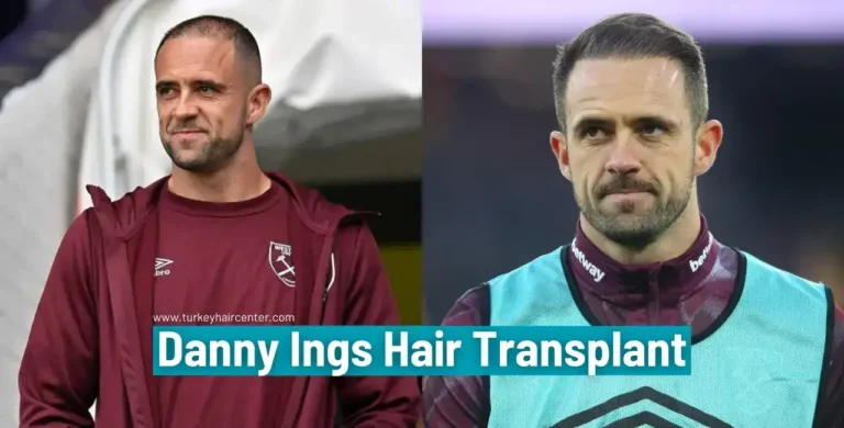 Danny-Ings-Hair-Transplant-4-1-768X390 Let’s Discover Succesfull Striker Danny Ings’ Hair Transplant 2026