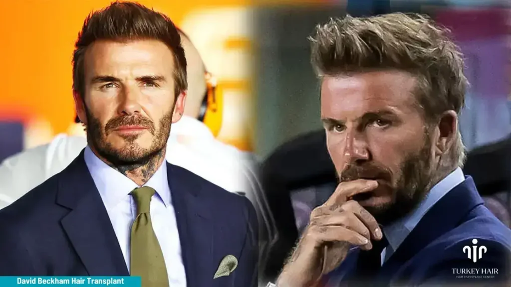 David-Beckham-Hair-Transplant-1-1-1 Unbelievably Story About David Beckham Hair Transplant 2026