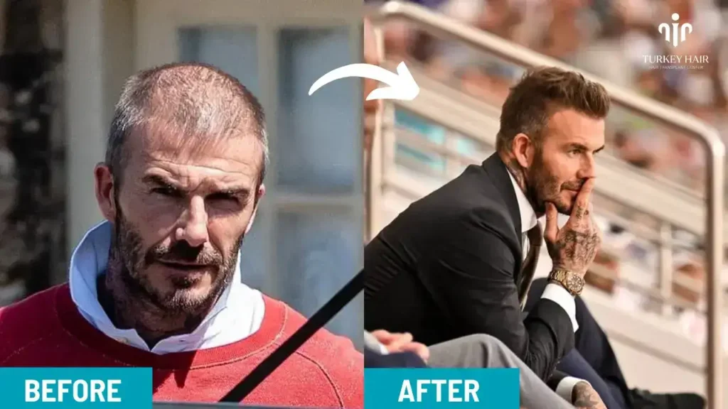 David-Beckham-Hair-Transplant-1-1 Unbelievably Story About David Beckham Hair Transplant 2026
