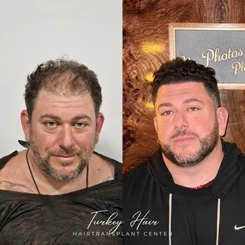 Fue Hair Transplant In Turkey – Cost, Before &Amp; After