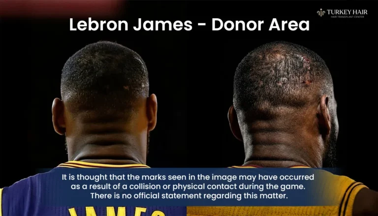 Lebron-James-Donor-Area-Back-Of-Head-Analysis-768X439 Lebron James Hair Transplant Journey: From Hair Loss To Full Comeback