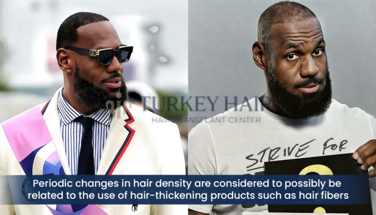 Lebron-James-Hair-Density-Changes-Hair-Fiber-Speculation-768X439 Lebron James Hair Transplant Journey: From Hair Loss To Full Comeback