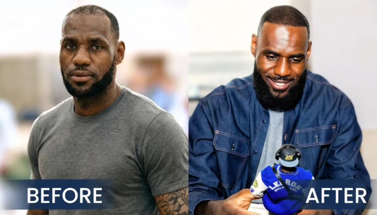 Lebron-James-Hair-Transplant-Before-After-Comparison-768X439 Lebron James Hair Transplant Journey: From Hair Loss To Full Comeback