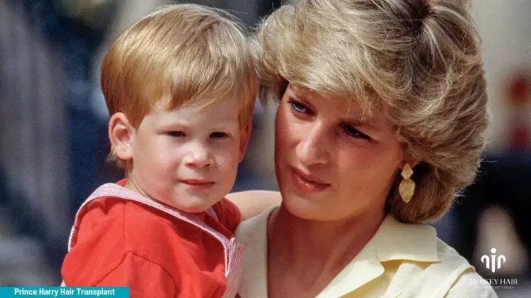 Join To Prince Harry Hair Transplant Journey