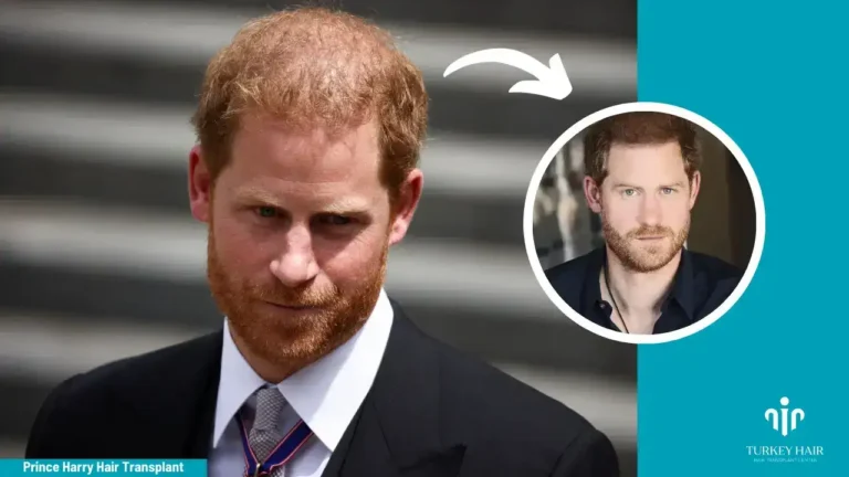 Join To Prince Harry Hair Transplant Journey