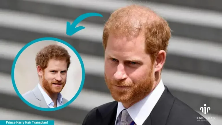 Join To Prince Harry Hair Transplant Journey