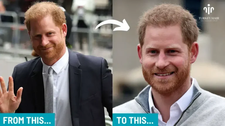 Join To Prince Harry Hair Transplant Journey