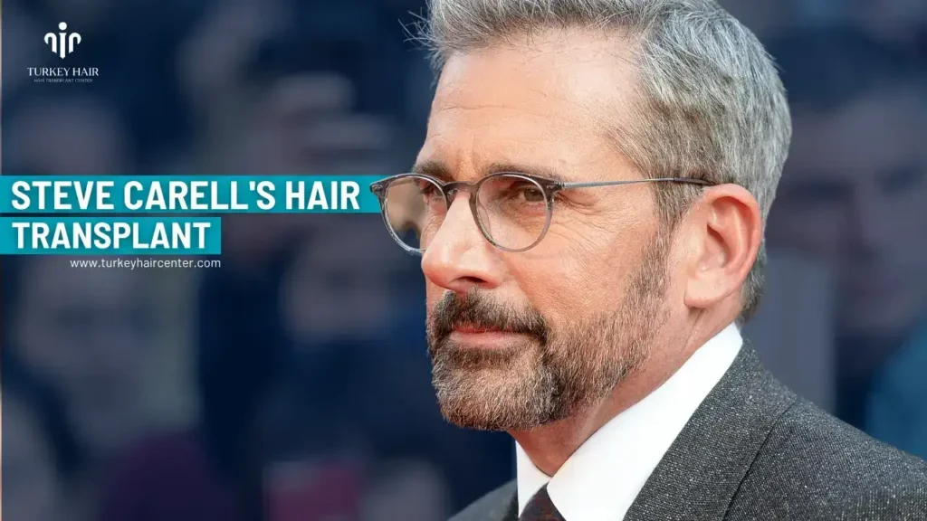#1 Actor Steve Carell’s Hair Transplant