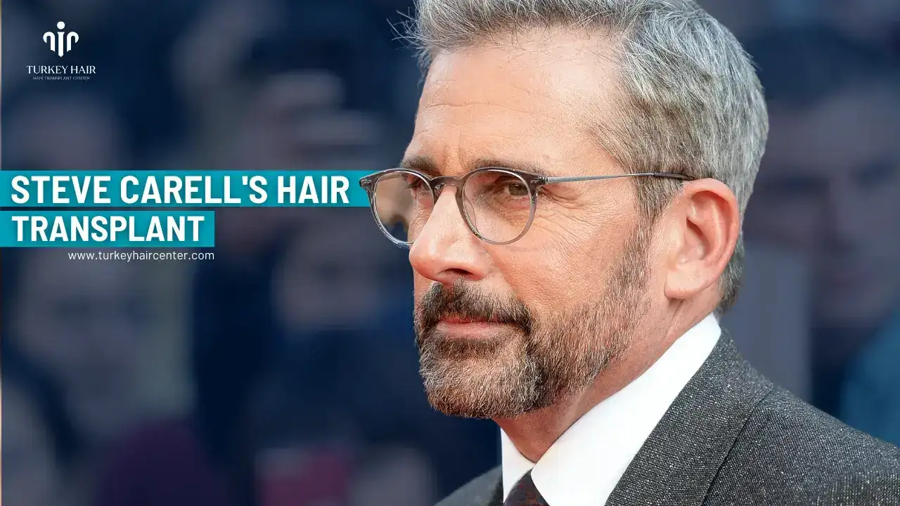 #1 Actor Steve Carell’s Hair Transplant 1 #1 Actor Steve Carell’s Hair Transplant