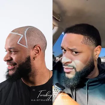 Tyrq.jpg 5000 Grafts Hair Transplant Turkey – Cost – Before And After