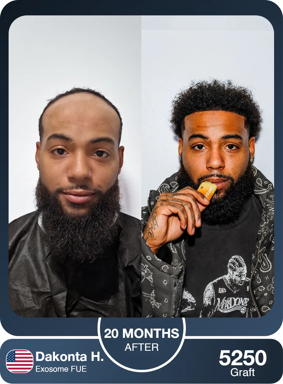 Fue Afro Hair Transplant Before And After Result