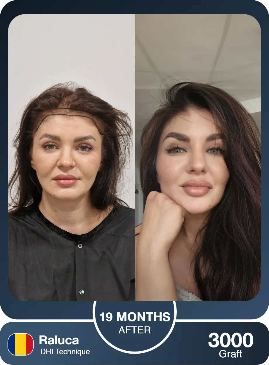 Female Hair Transplant Before And After Result