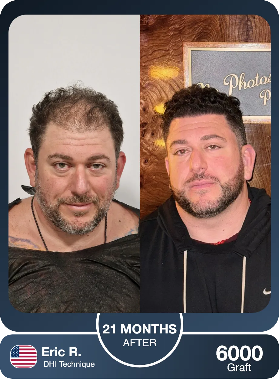 Dhi Hair Transplant Before And After Comparison