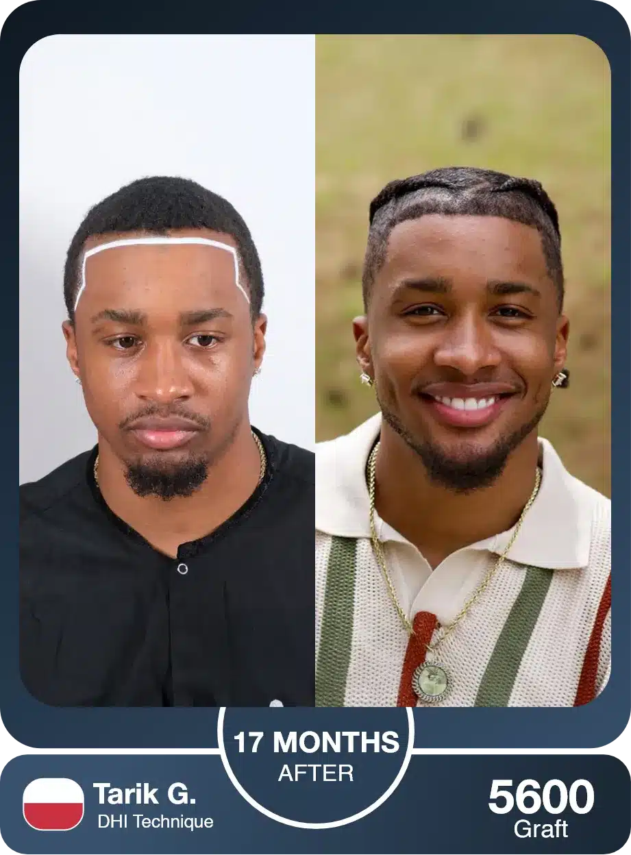 Turkey Hair Center Nigeria | Afro Hair Transplant In Lagos 8 Afro Hair Transplant Before And After — Dhi Technique, 5600 Grafts, 17 Months