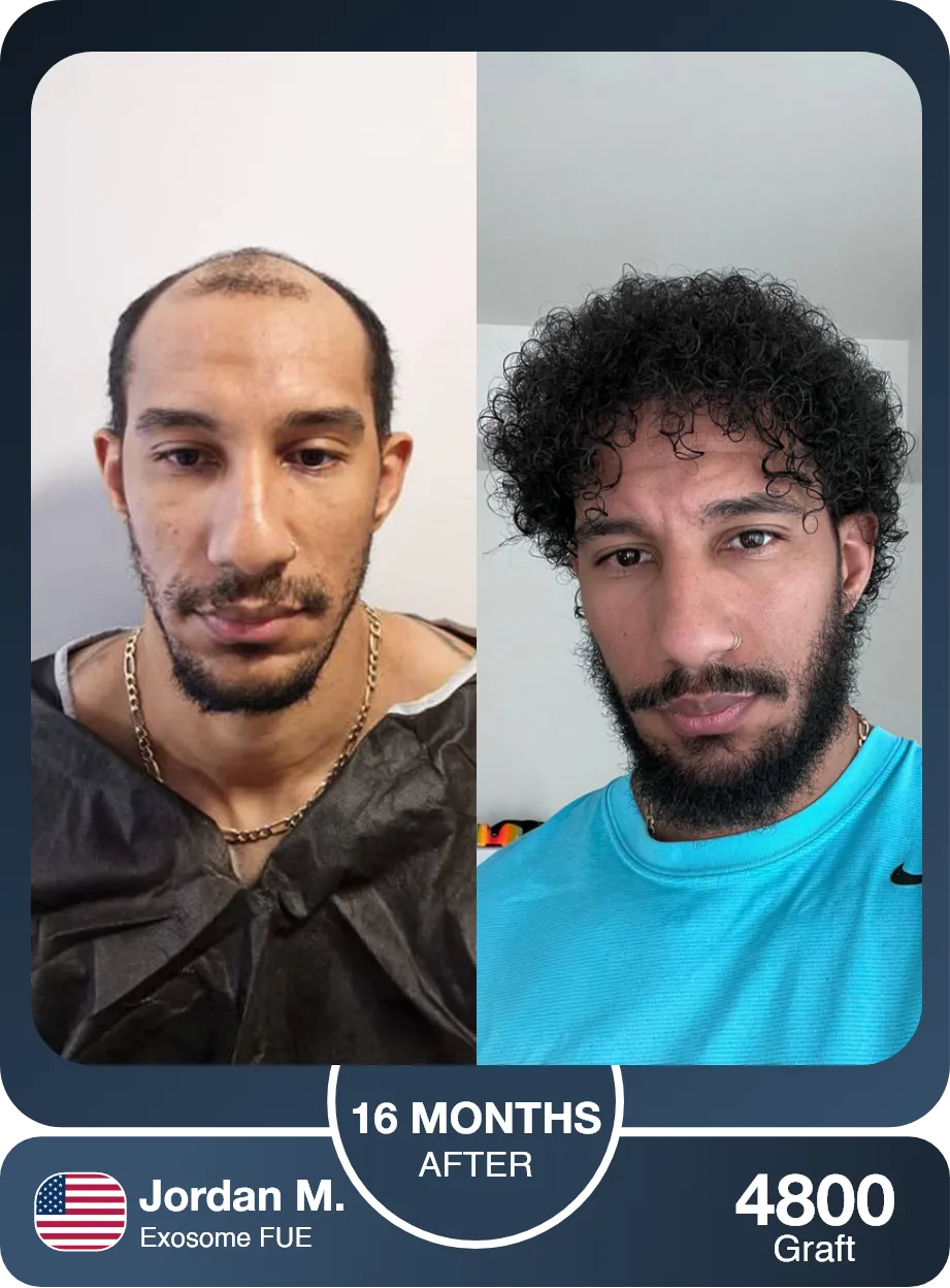 Exsome Afro Hair Transplant Before And After Result