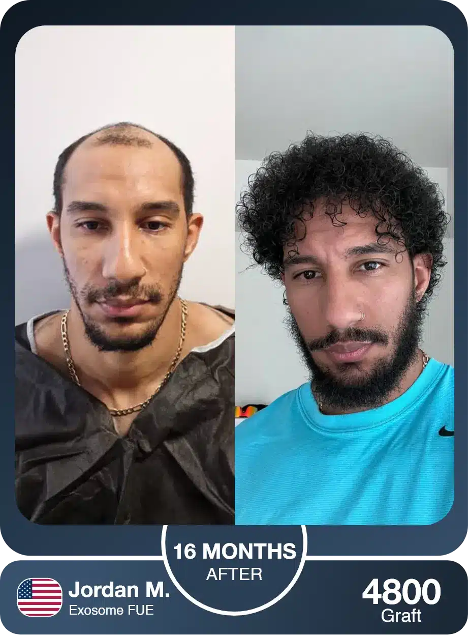 Turkey Hair Center Nigeria | Afro Hair Transplant In Lagos 9 Afro Hair Transplant Before And After — Case 3