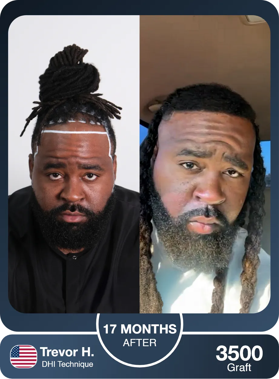 Afro Dhi Hair Transplant Before And After Comparison