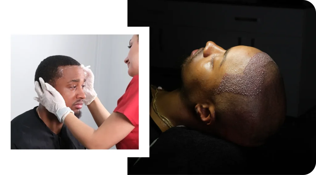 Hair Transplant Before And During Procedure Hair Transplant Before Procedure And During Operation