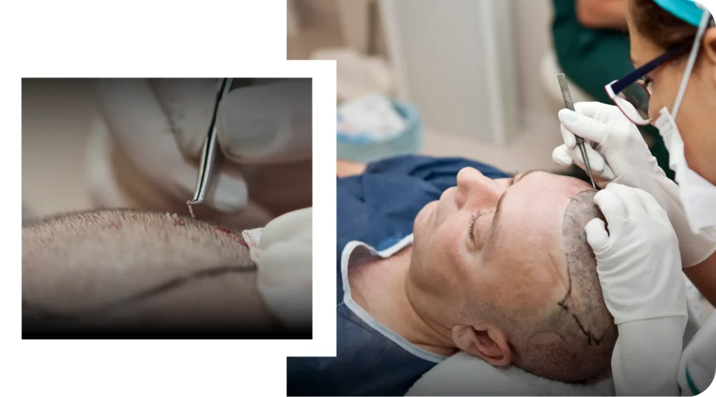 Hair Transplant Surgery – Fue Procedure In Progress Hair Transplant Procedure In Progress At A Modern Clinic Using World Record