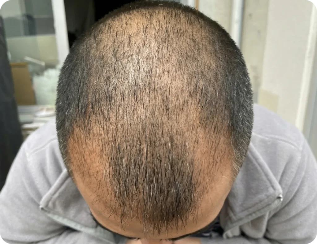 1–3 Months After Hair Transplant – Shock Loss Hair Transplant Shock Loss 1 To 3 Months After Procedure