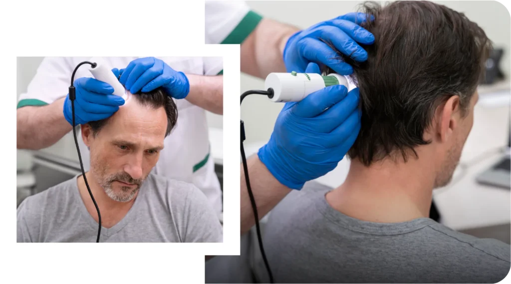 Pre Hair Transplant Haircut Hair Trimmed Before Hair Transplant Procedure
