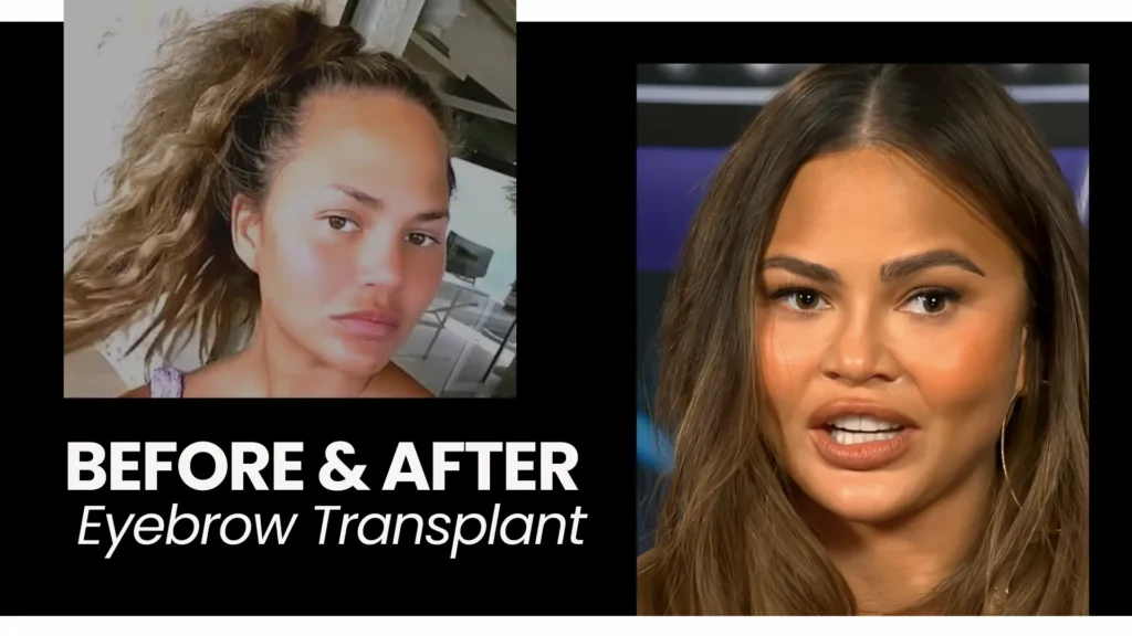 Eyebrow Transplant In Turkey – Cost, Before &Amp; After 10 Eyebrow Transplant Before And After