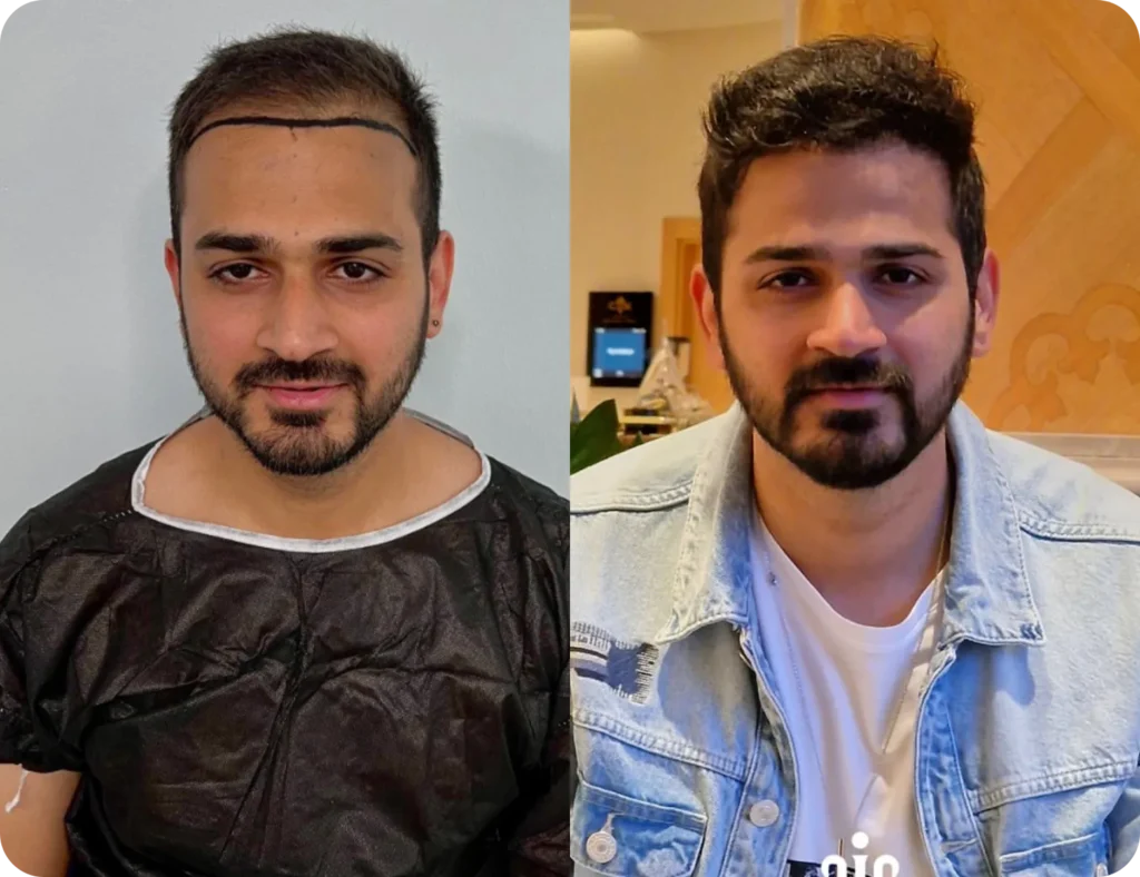 Before And After Hair Transplant Before And After Hair Transplant Results Showing Transformation