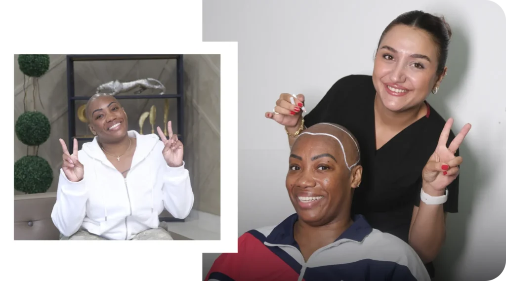 Female Hairline Design Before Hair Transplant Hairline Design Before Hair Transplant For Female Patient In Turkey