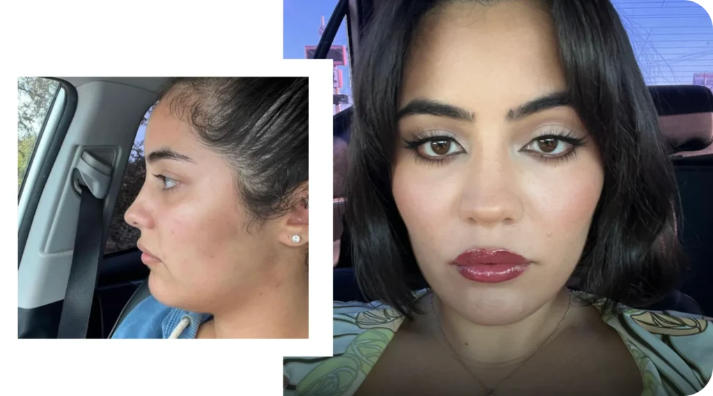 Female Hair Transplant Before And After Female Hair Transplant Before And After Results