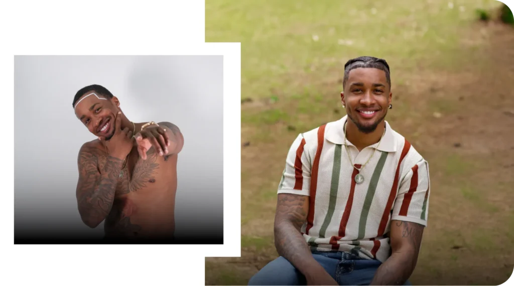 Before And After Hair Transplant Results Before And After Hair Transplant Results Showing Natural Hair Restoration