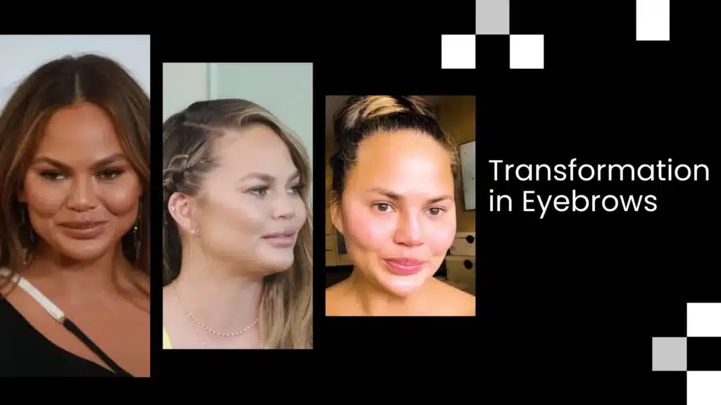 Eyebrow Transplant In Turkey – Cost, Before &Amp; After 9 Eyebrow Transplant Transformation Before And After