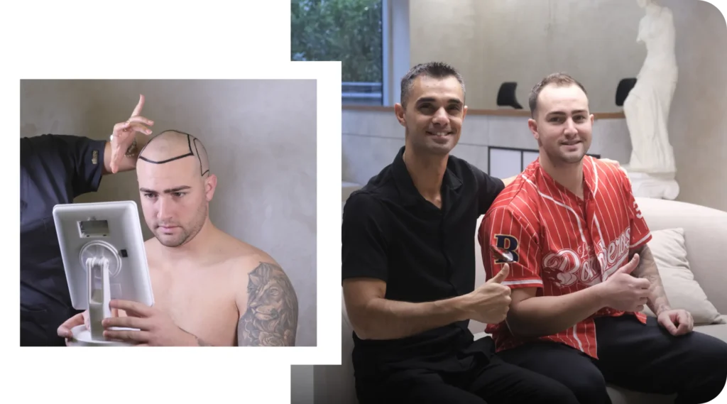Hairline Design With Happy Patient Happy Patient With Drawn Hairline Before Hair Transplant