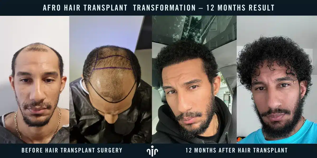 Afro Hair Transplant In Turkey, Cost, Before &Amp; After 14 Final Results Are Typically Visible After 12 Months, With Full Hair Growth And Natural Density Achieved.