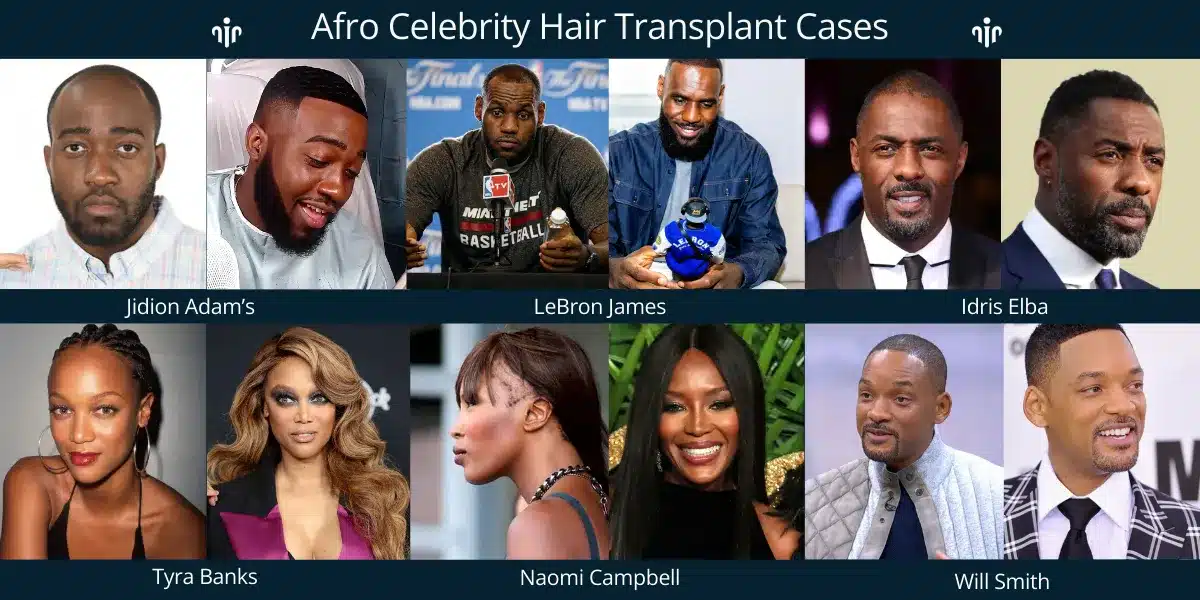 Afro Hair Transplant In Turkey, Cost, Before &Amp; After 17 Afro Celebrity Hair Transplant Results Highlight Natural Hairline Design And Successful Restoration For Curly Hair Types.