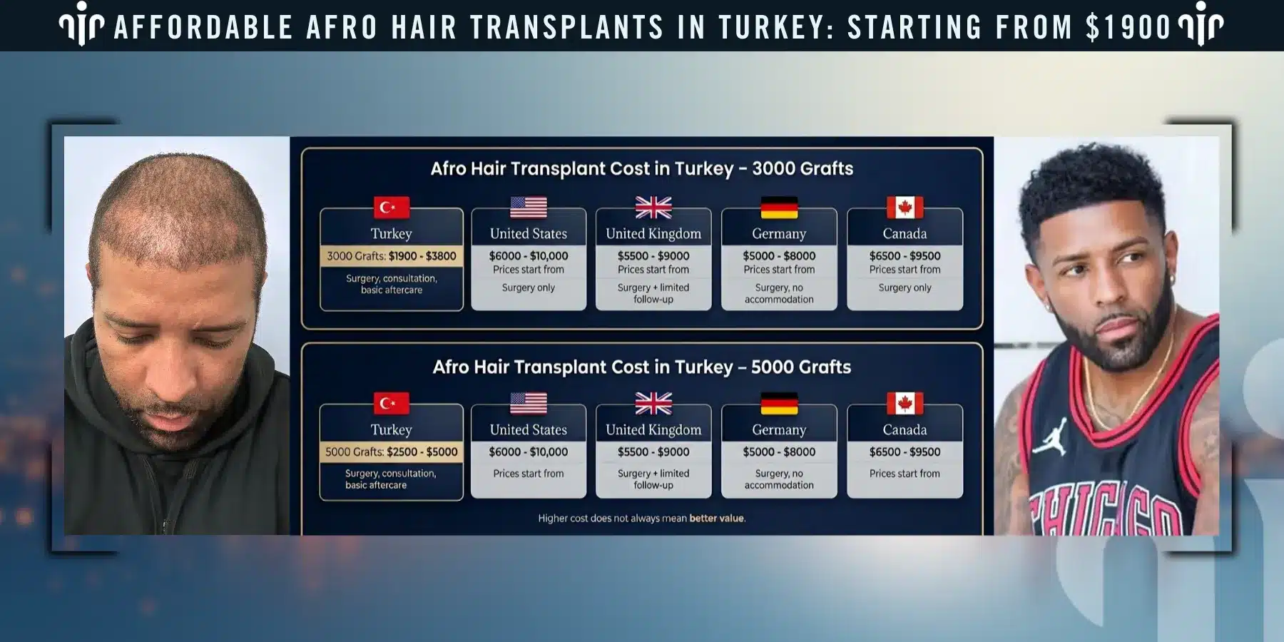 Afro Hair Transplant In Turkey, Cost, Before &Amp; After 9 Afro Hair Transplant Cost Varies Depending On The Number Of Grafts, Hair Type, And The Complexity Of The Procedure.